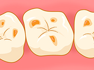 虫歯は、ミュータンス菌という細菌が酸を出し、歯を溶かすことで起こる病気です。