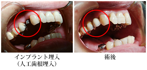 インプラント埋入