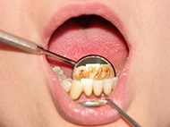 歯周病とは歯茎の炎症から始まり進行すると歯を支える歯のまわりの組織や顎の骨を溶かしていく病気です。