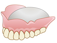 金属床義歯