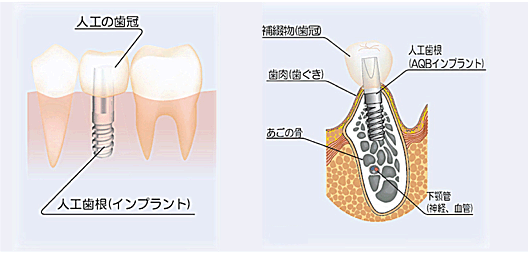 インプラント治療って？