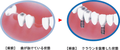 インプラントイメージ